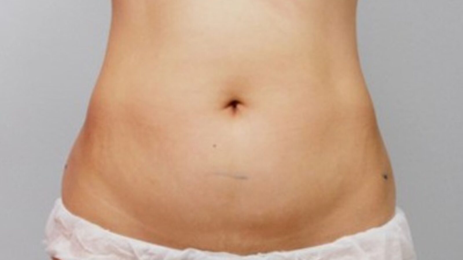 Waist - after 3 HIFU sessions (Classys clinical case study)