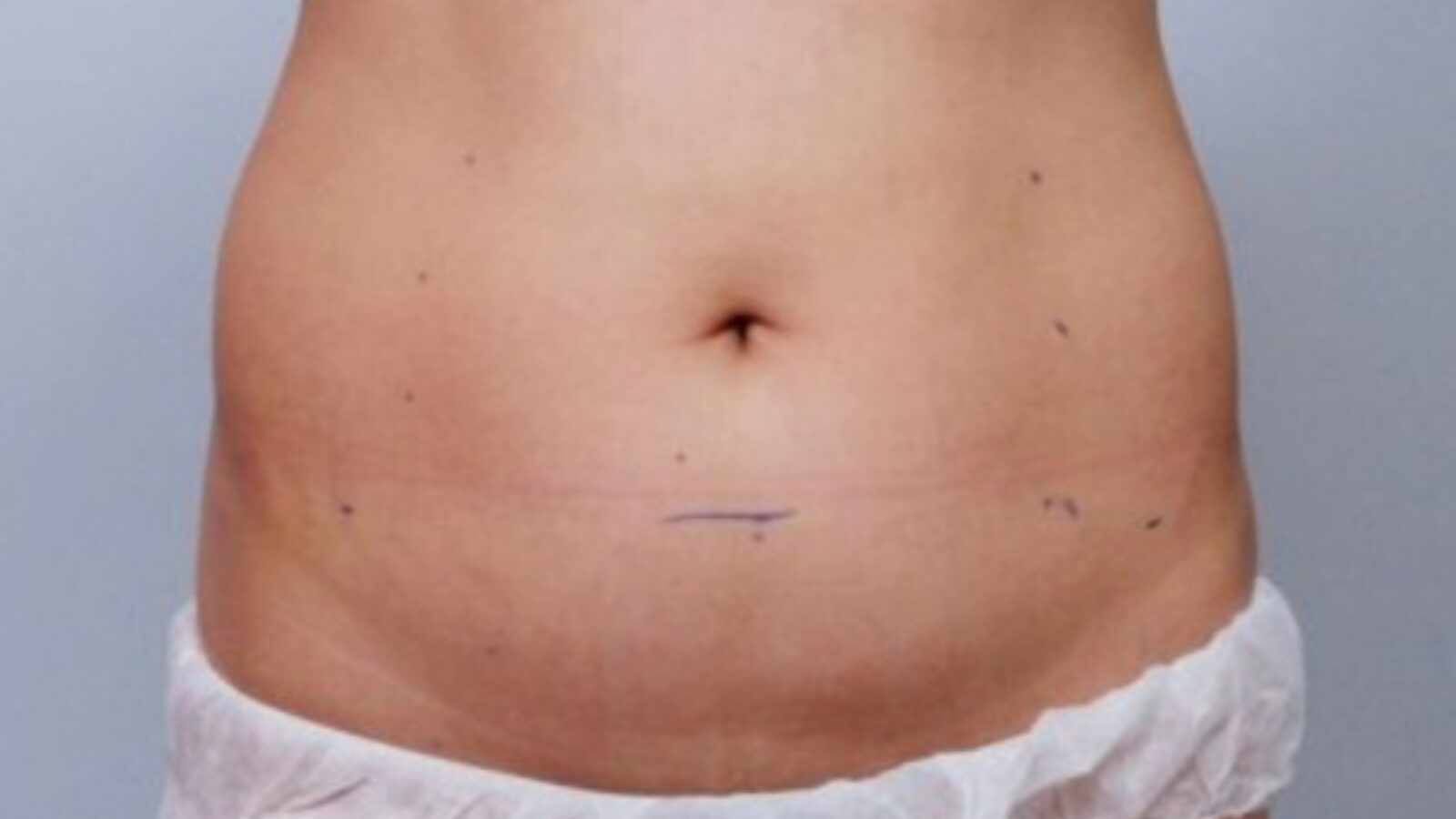 Waist - before HIFU treatment (Classys clinical case study)