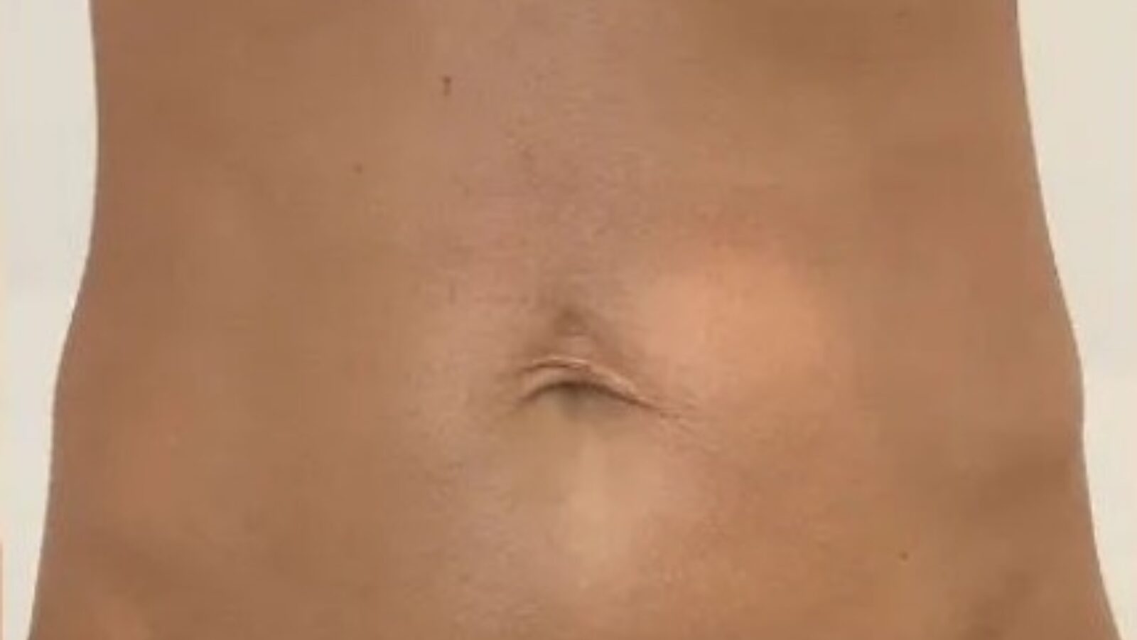 Abdomen - after HIFU treatment