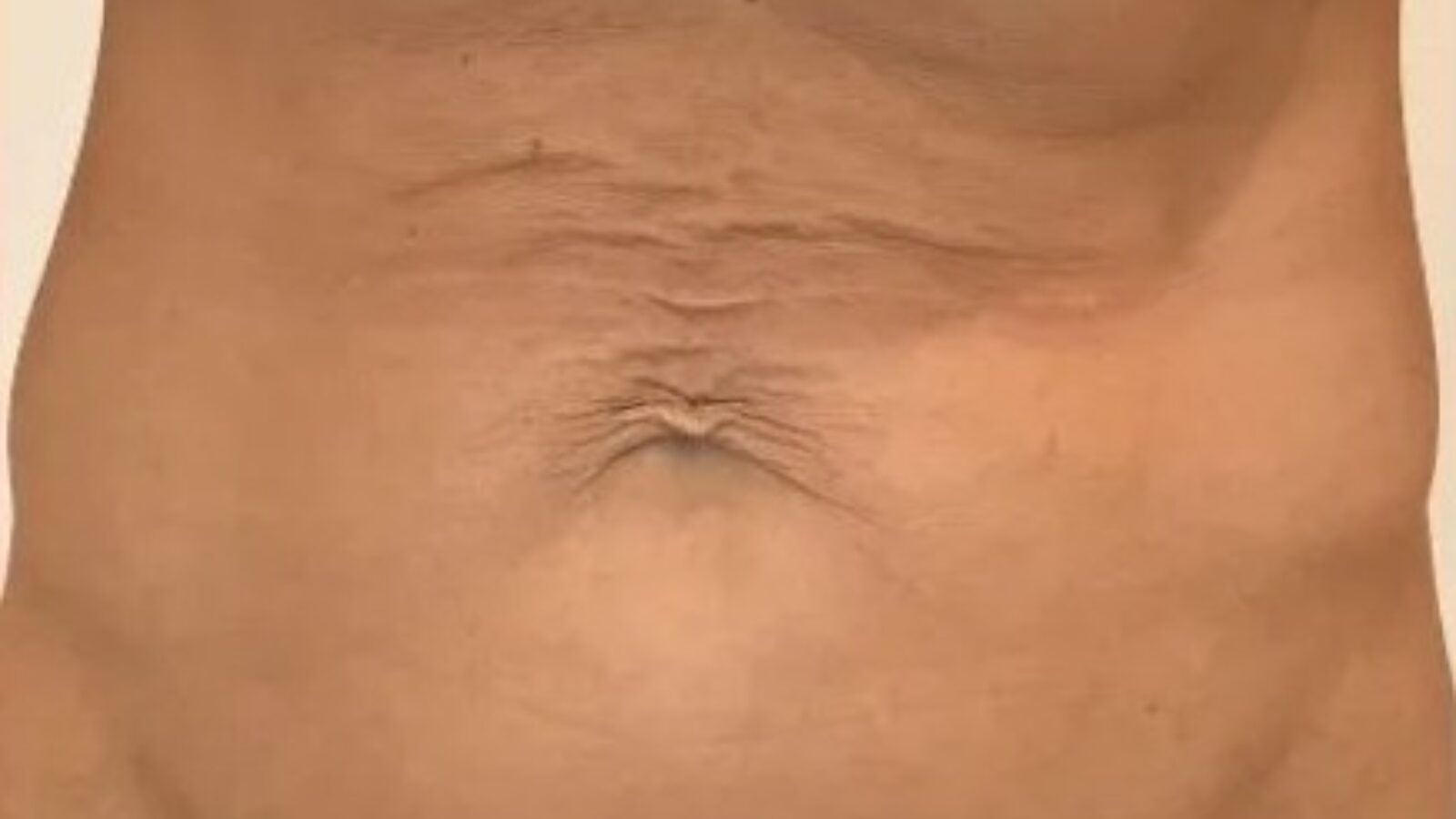Abdomen - before HIFU treatment