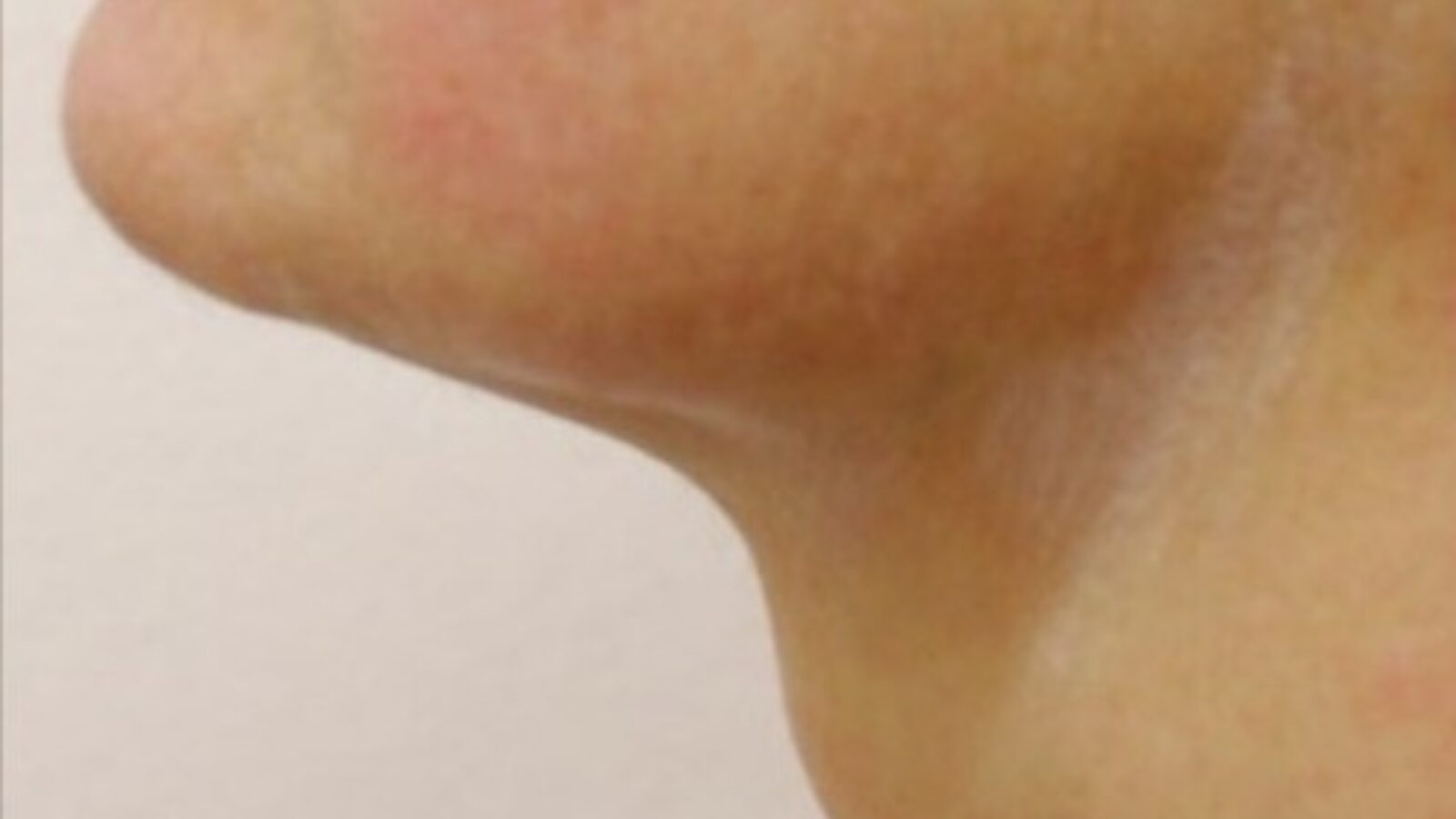 Double chin - after 2 HIFU sessions