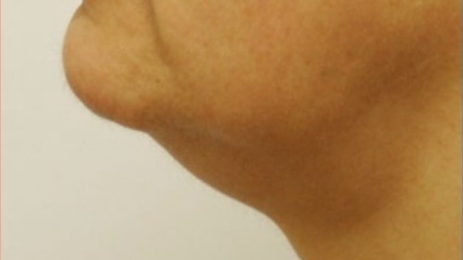 Double chin - before HIFU treatment