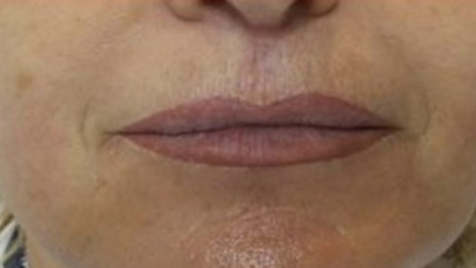 Perioral lines (smoker's lines) - after 1 HIFU session