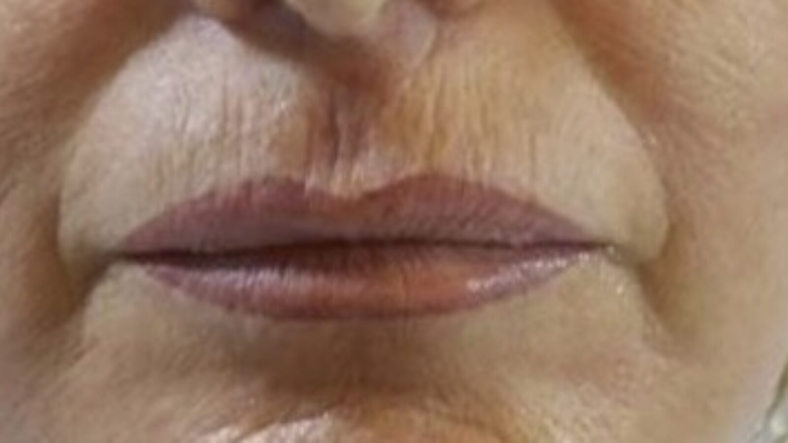 Perioral lines (smoker's lines) - before HIFU treatment