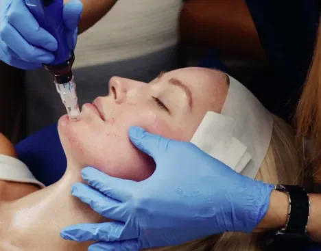 Skin Pen microneedling prices