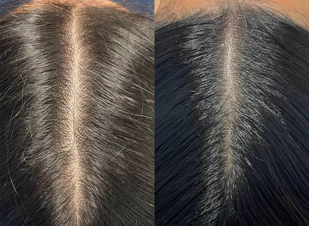 Hydrafacial keravive before after antwerpen