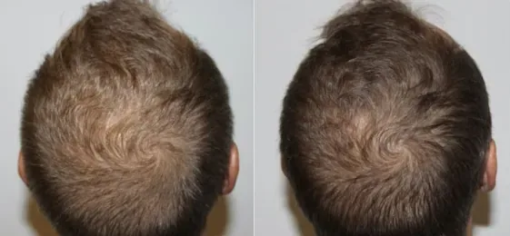 Keravive Before And After antwerpen