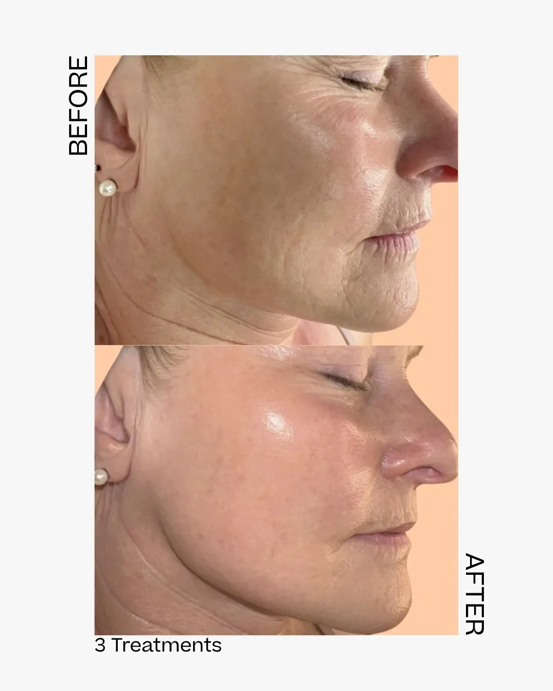 Skinpen before after antwerpen 4