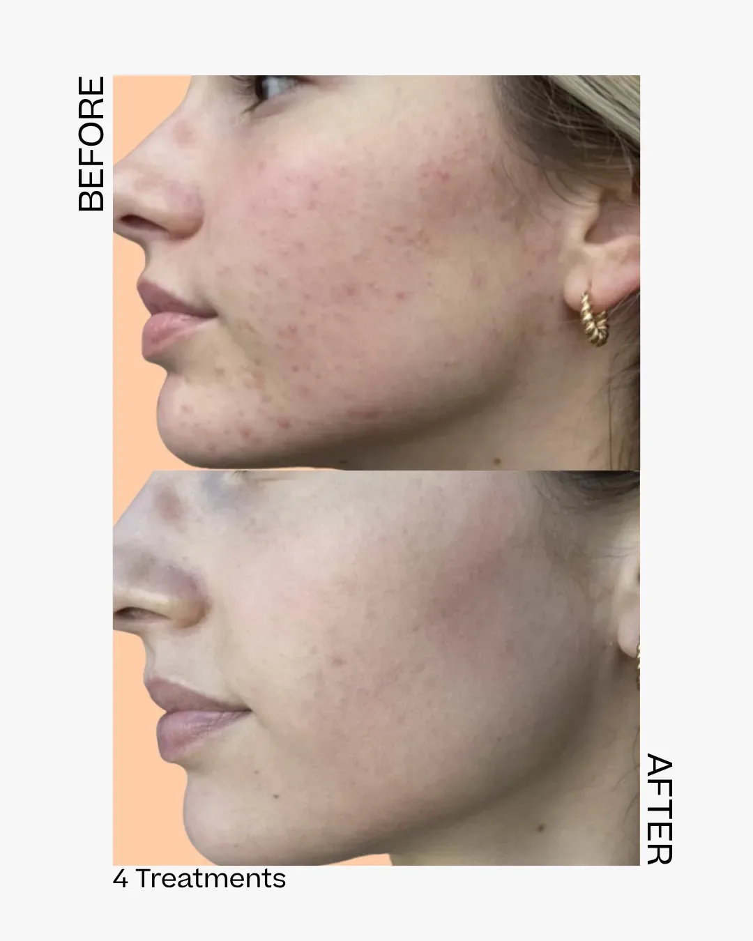 Skinpen before after antwerpen 3