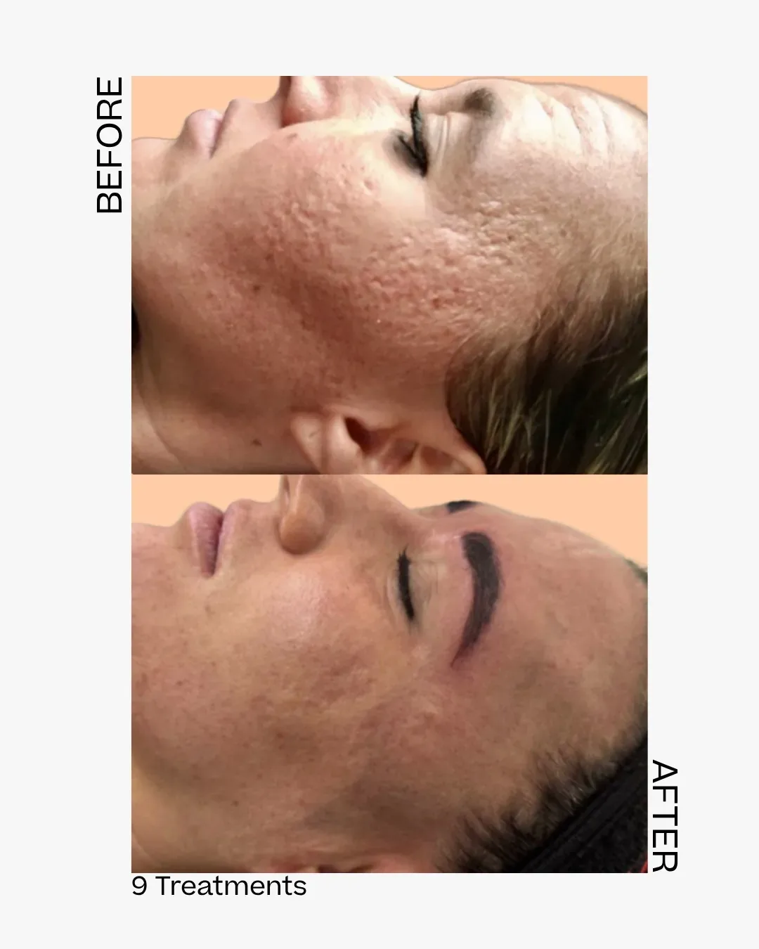 Skinpen before after antwerpen 2