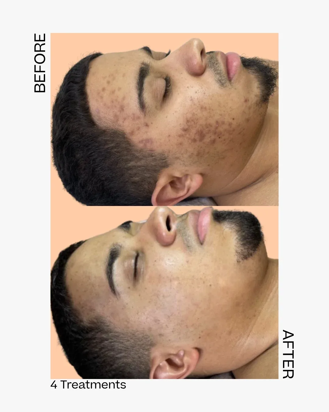 Skinpen before after antwerpen